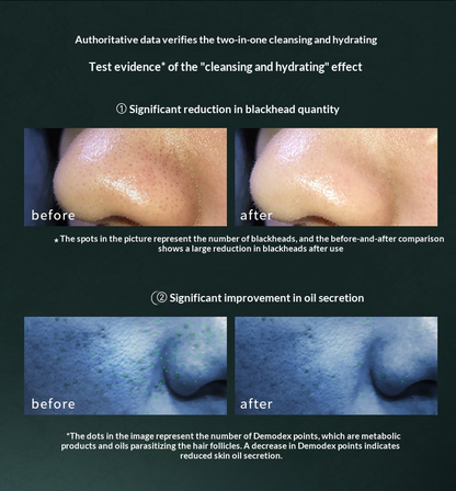 Blackhead Vacuum + Oxygen Spray | Pore Cleansing & Serum Infusion Device
